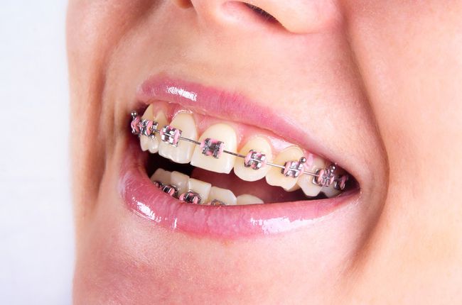BRACES BRACES